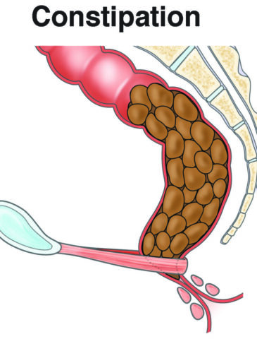 Constipation treatment nagpur