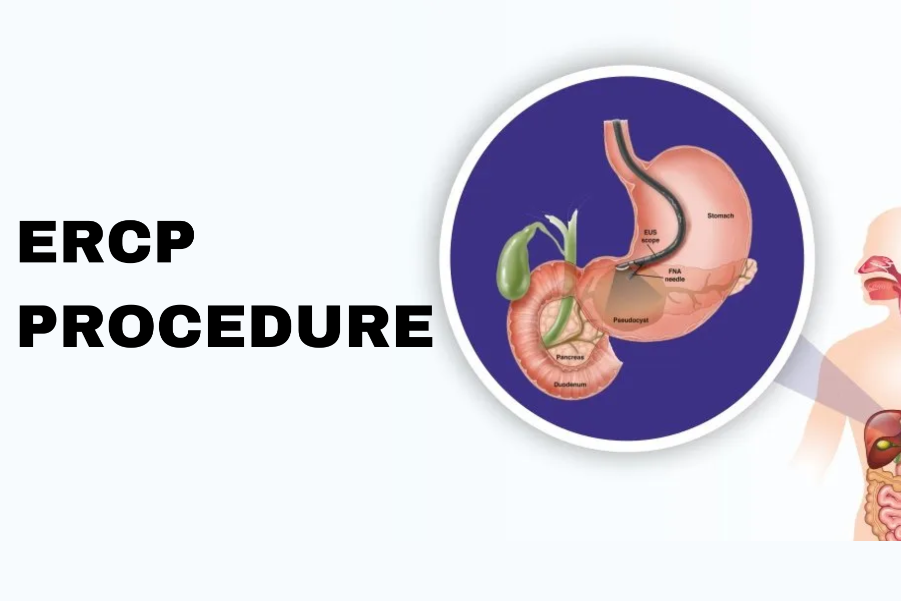 ERCP Procedure nagpur