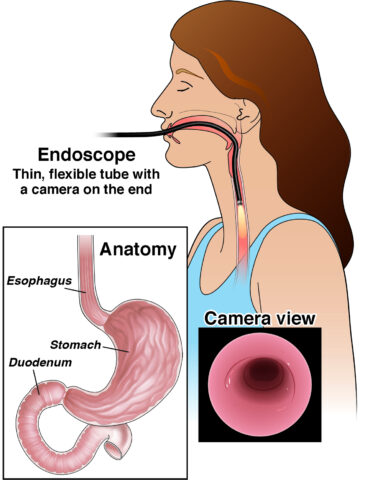 Endoscopy test in nagpur