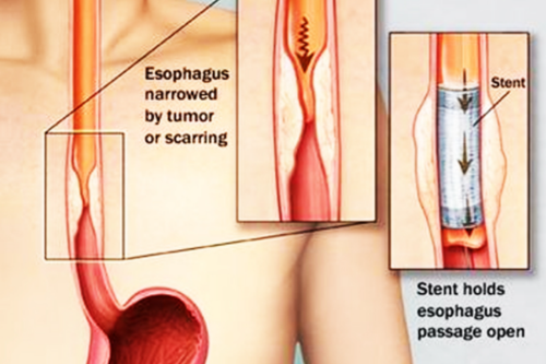 Esophageal Stenting