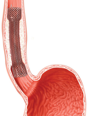 Esophageal stenting nagpur