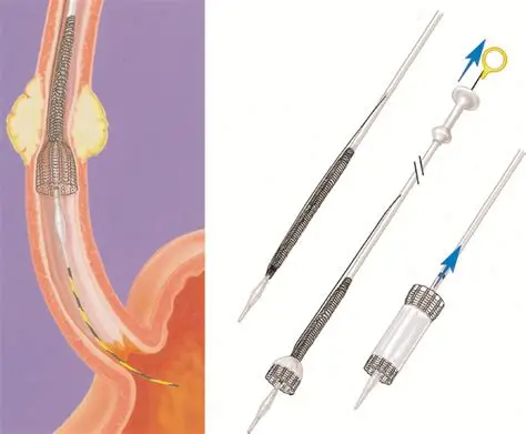 Esophageal stenting nagpur
