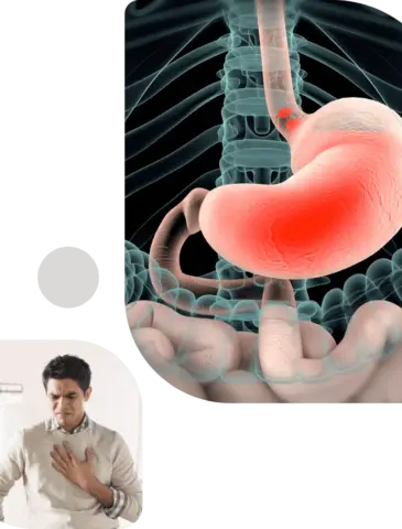 GERD-Treatment nagpur