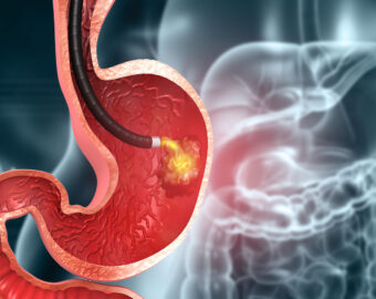 Gastritis treatment nagpur