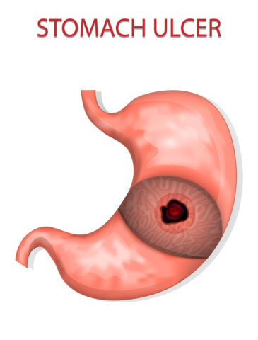 Ulcer bleeding treatment nagpur